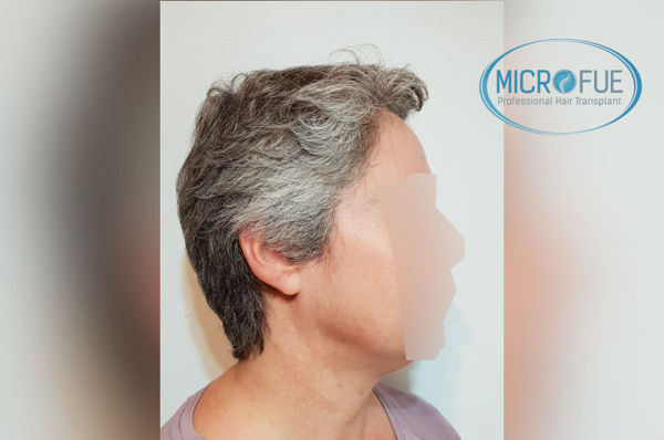 Trasplante capilar en mujeres - Antes y después Trasplante capilar en mujeres - Antes y después
