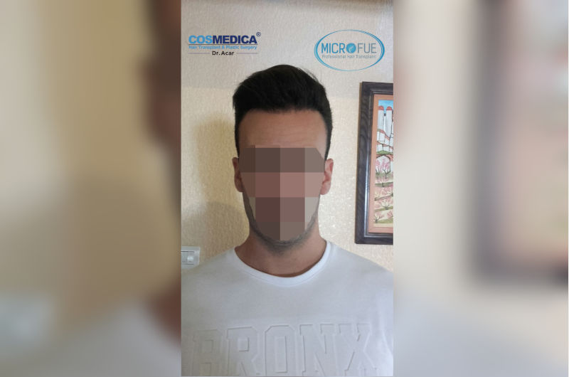 antes-y-despues-micro-injerto-de-pelo-en-turquia antes-y-despues-micro-injerto-de-pelo-en-turquia