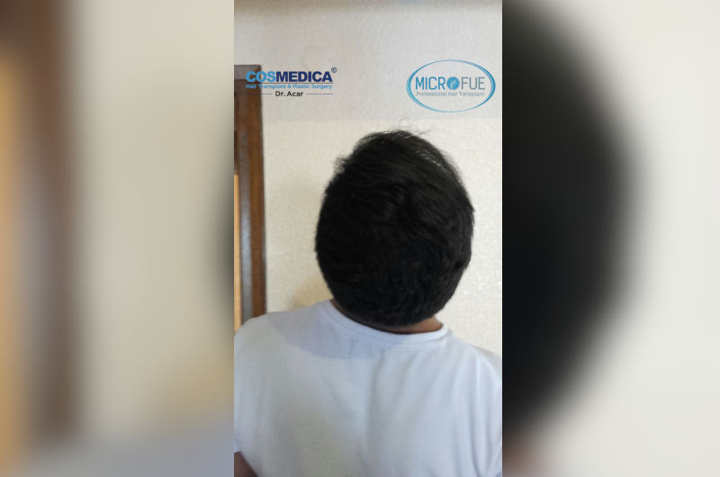 antes-y-despues-trasplante-de-pelo-en-turquia antes-y-despues-trasplante-de-pelo-en-turquia
