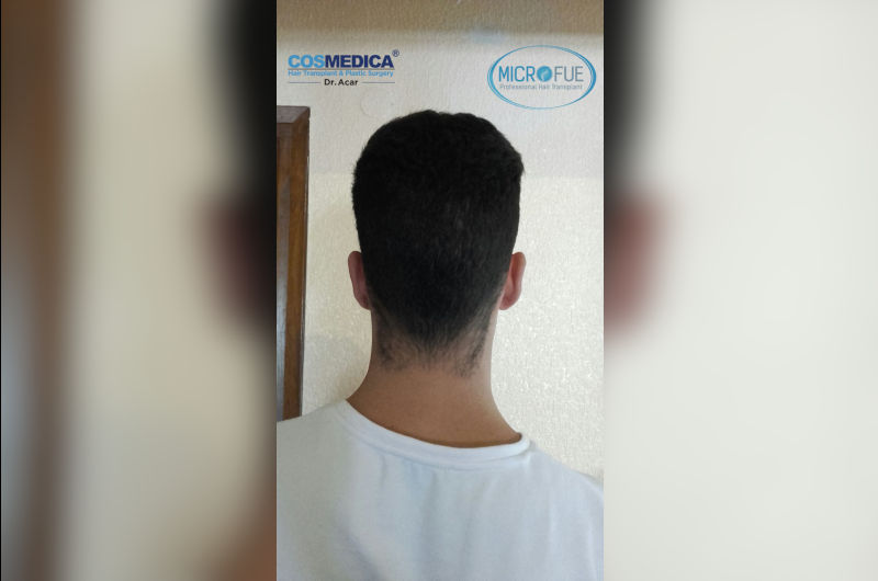 antes-y-despues-injerto-de-pelo-en-turquia antes-y-despues-injerto-de-pelo-en-turquia