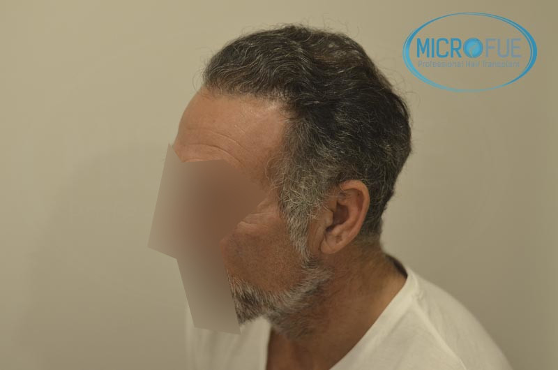 trasplante capilar en turquia antes y despues trasplante capilar en turquia antes y despues