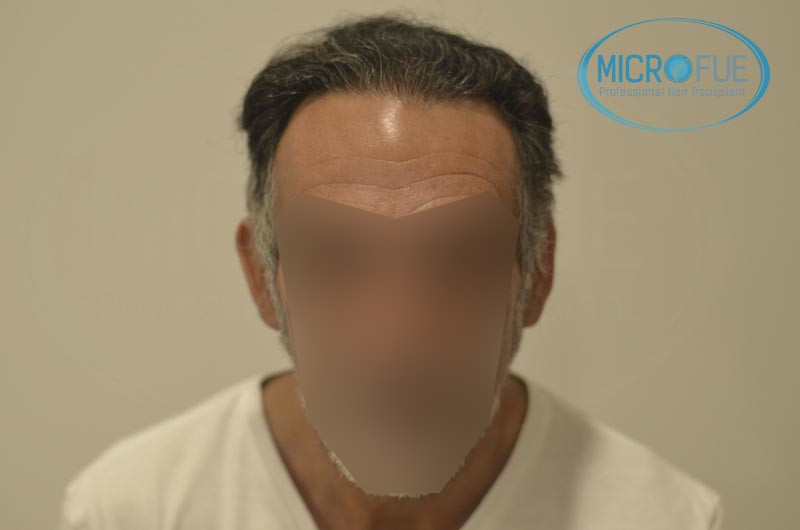 trasplante de pelo en turquia antes y despues trasplante de pelo en turquia antes y despues