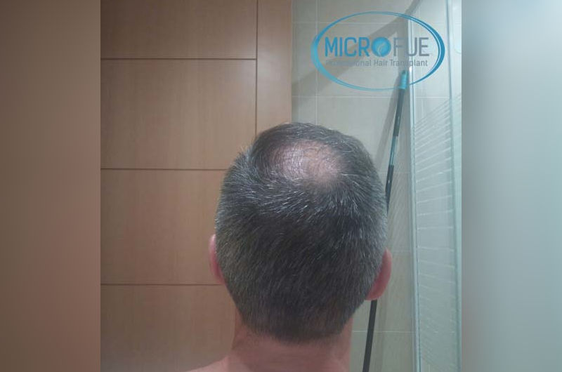 trasplante de pelo en turquia antes y despues trasplante de pelo en turquia antes y despues