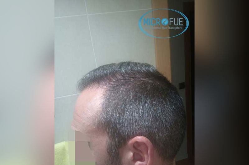 trasplante capilar en turquia comparación antes y despues trasplante capilar en turquia comparación antes y despues