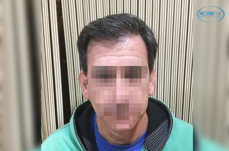 resultados de trasplante de pelo en Turquía con Microfue resultados de trasplante de pelo en Turquía con Microfue