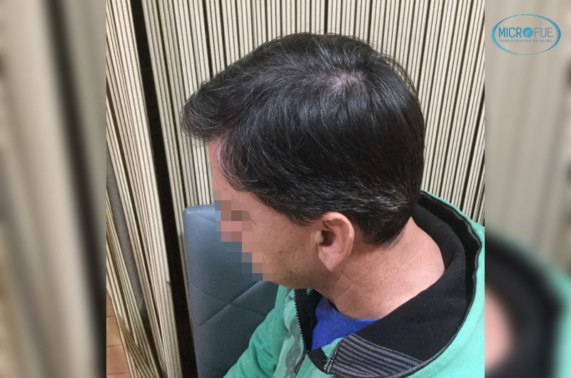 resultados trasplante capilar en Estambul tras un año resultados trasplante capilar en Estambul tras un año