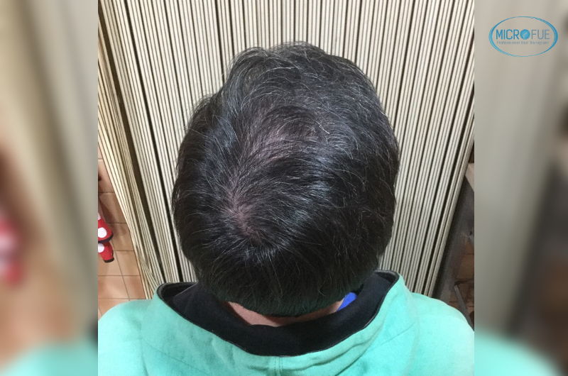 resultados coronilla cubierta tras trasplante capilar Microfue en Turquía resultados coronilla cubierta tras trasplante capilar Microfue en Turquía
