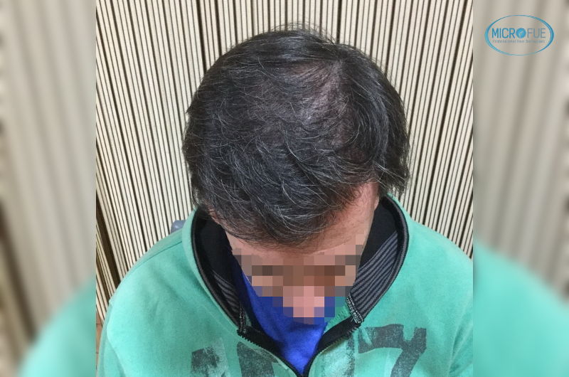 trasplante de pelo en Turquía muy buenos resultados trasplante de pelo en Turquía muy buenos resultados