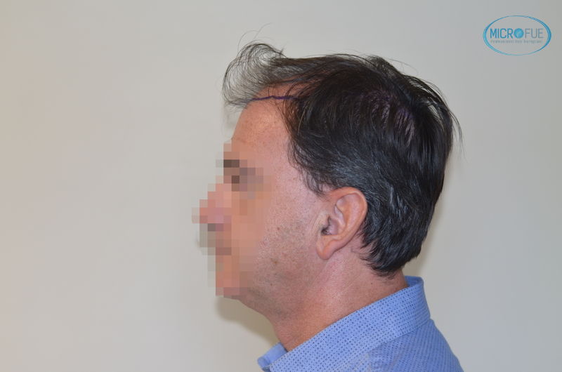 trasplante de pelo en Estambul fotografía lateral de la cabeza