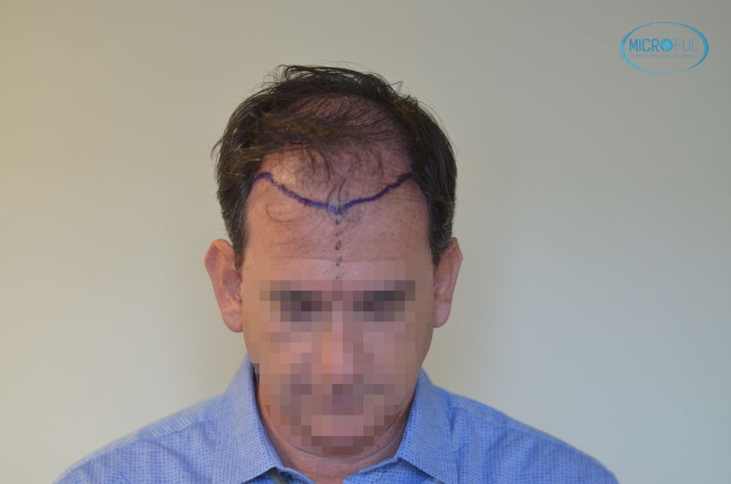 trasplante capilar en Turquía parte frontal trasplante capilar en Turquía parte frontal