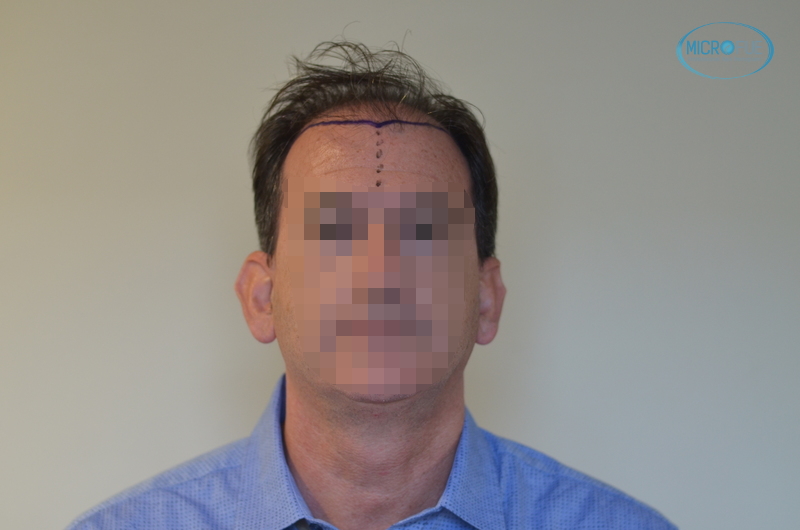trasplante de pelo en Turquía con Microfue entradas y parte frontal de la cabeza