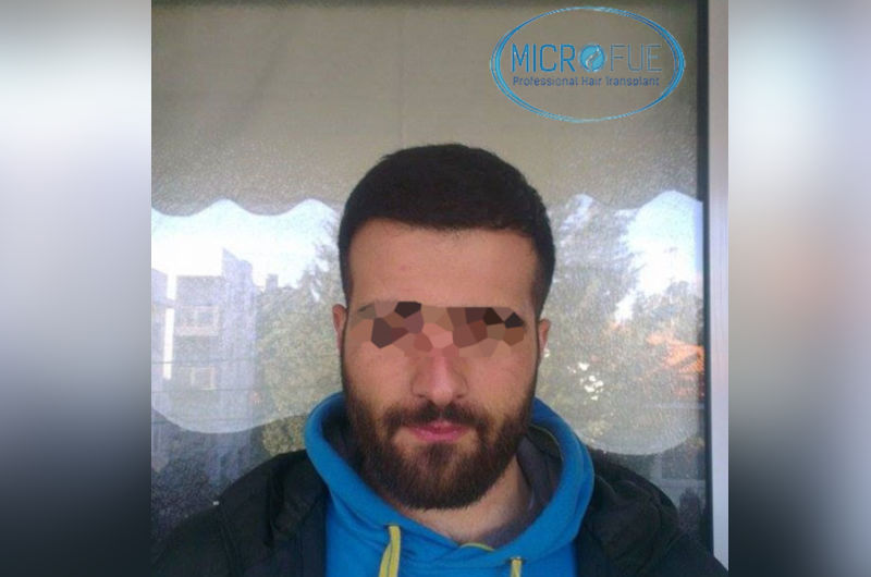 trasplante-de-pelo-en-turquia-opiniones-microfue-2 trasplante-de-pelo-en-turquia-opiniones-microfue-2