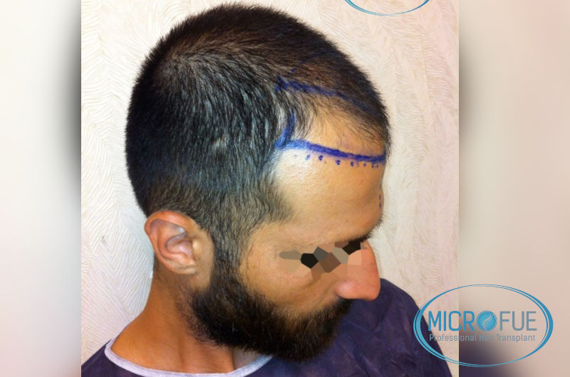 trasplante-de-pelo-en-turquia-opiniones-microfue-3 trasplante-de-pelo-en-turquia-opiniones-microfue-3