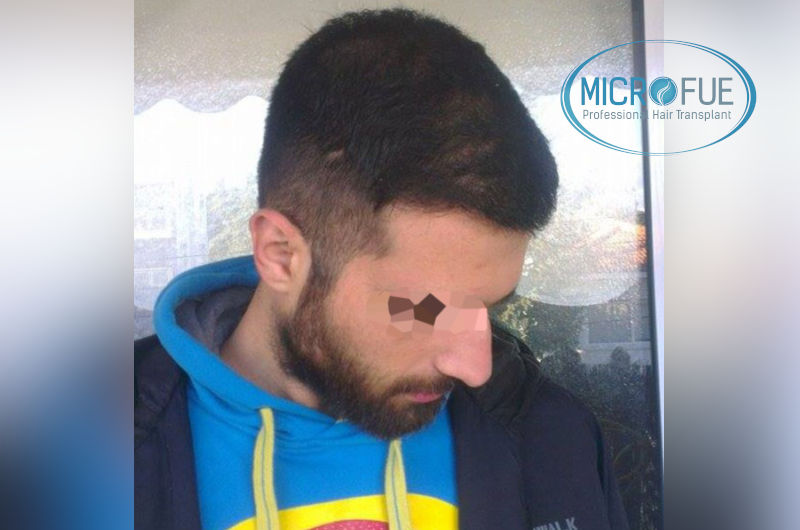 trasplante-de-pelo-en-turquia-opiniones-microfue-4 trasplante-de-pelo-en-turquia-opiniones-microfue-4