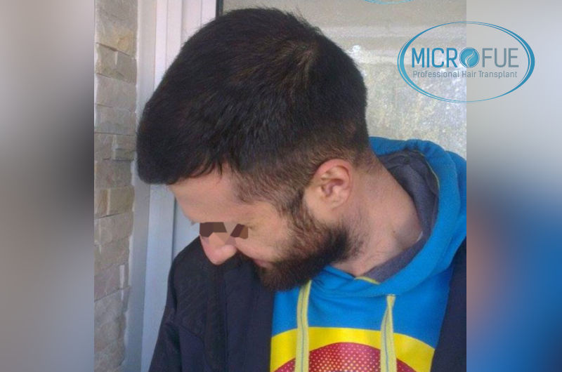 trasplante-de-pelo-en-turquia-opiniones-microfue-5 trasplante-de-pelo-en-turquia-opiniones-microfue-5
