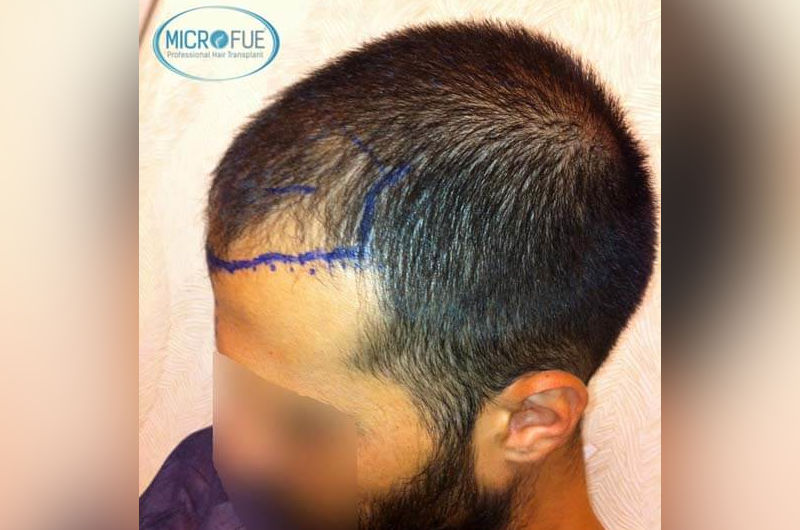 trasplante-de-pelo-en-turquia-opiniones-microfue-6 trasplante-de-pelo-en-turquia-opiniones-microfue-6