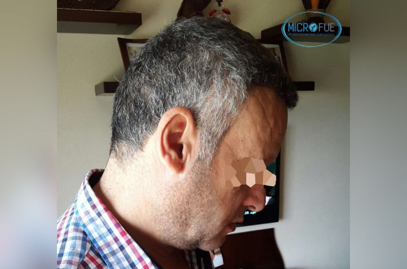 Trasplante de pelo entradas y coronillas Trasplante de pelo entradas y coronillas