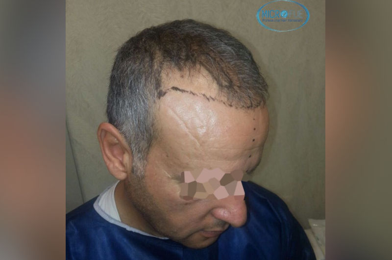 Trasplante de pelo entradas y coronillas Trasplante de pelo entradas y coronillas