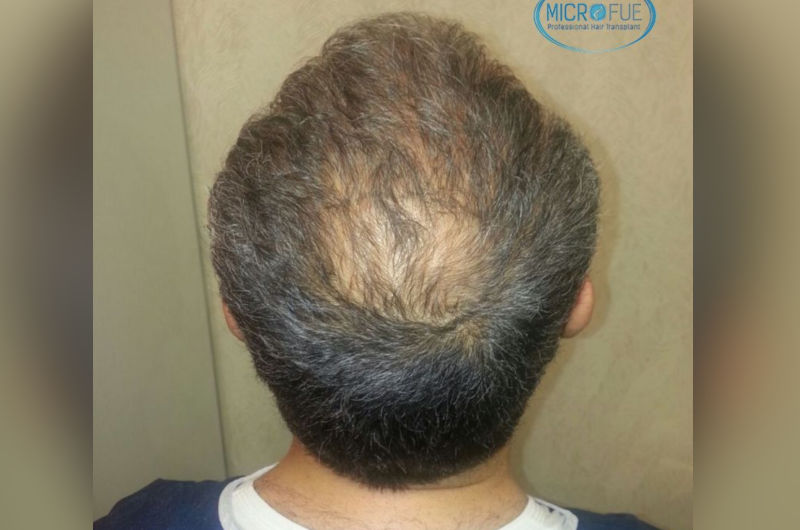Trasplante de pelo entradas y coronillas Trasplante de pelo entradas y coronillas