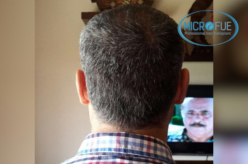 Trasplante de pelo entradas y coronillas Trasplante de pelo entradas y coronillas