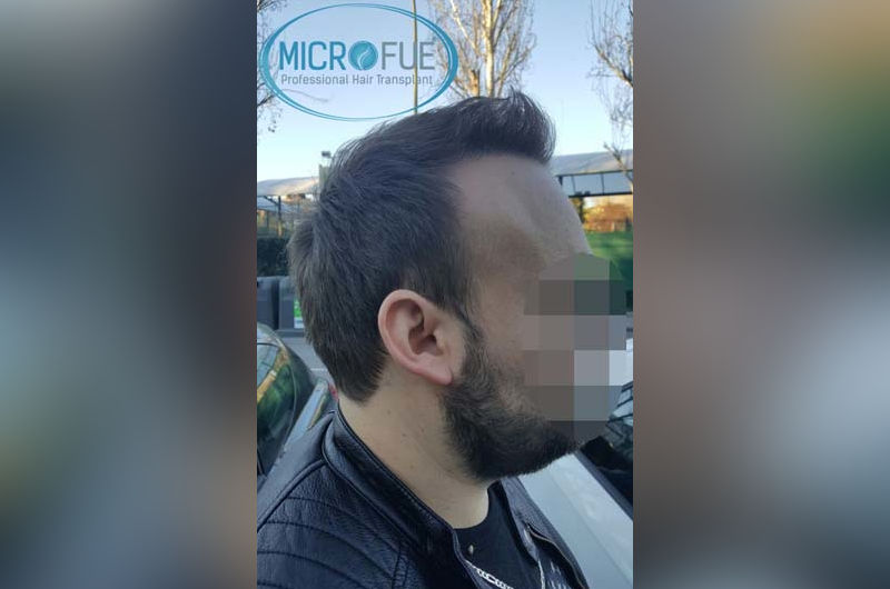 Trasplante de pelo en Turquía después de 6 meses Trasplante de pelo en Turquía después de 6 meses