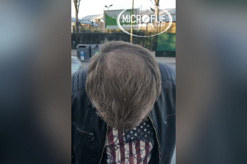 Trasplante de pelo en Turquía después de 6 meses Trasplante de pelo en Turquía después de 6 meses