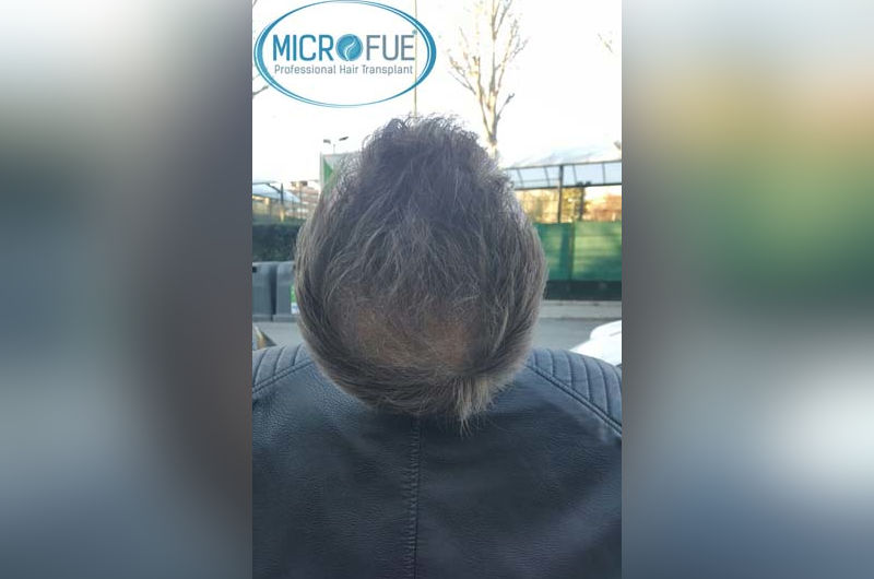 Trasplante de pelo en Turquía después de 6 meses