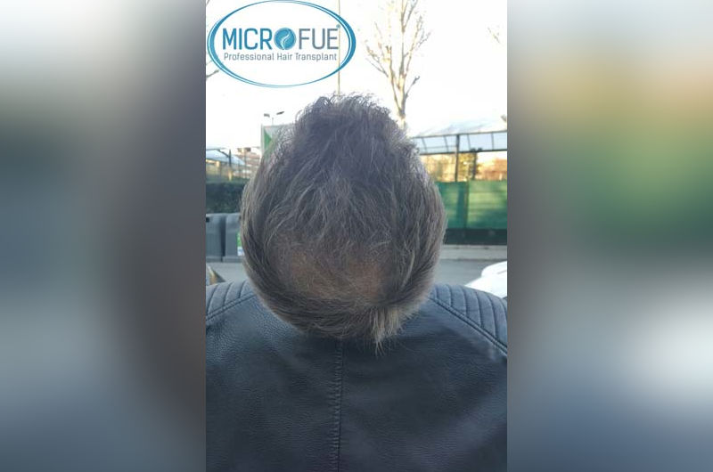 Trasplante de pelo en Turquía después de 6 meses Trasplante de pelo en Turquía después de 6 meses