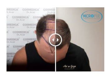 trasplante de cabello causa impotencia trasplante de cabello causa impotencia
