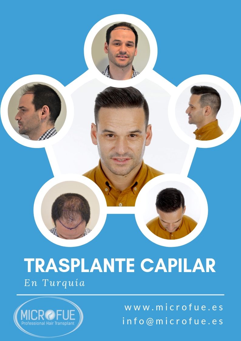 Por-que-ir-a-turquia-para-trasplante-capilar microfue - por que turquia trasplante capilar
