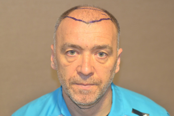 trasplante de pelo milinko pantic - pacientes de microfue trasplante de pelo milinko pantic - pacientes de microfue