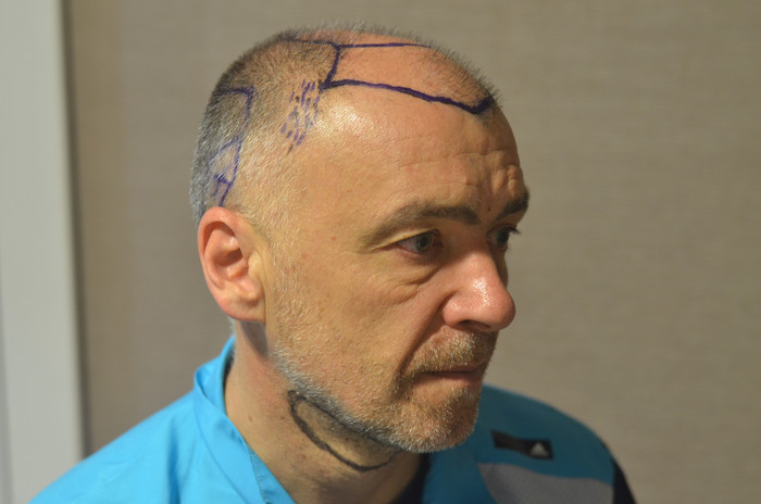 trasplante de pelo milinko pantic - pacientes de microfue trasplante de pelo milinko pantic - pacientes de microfue