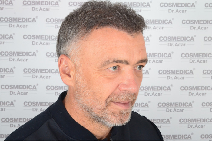 trasplante de pelo milinko pantic - pacientes de microfue trasplante de pelo milinko pantic - pacientes de microfue
