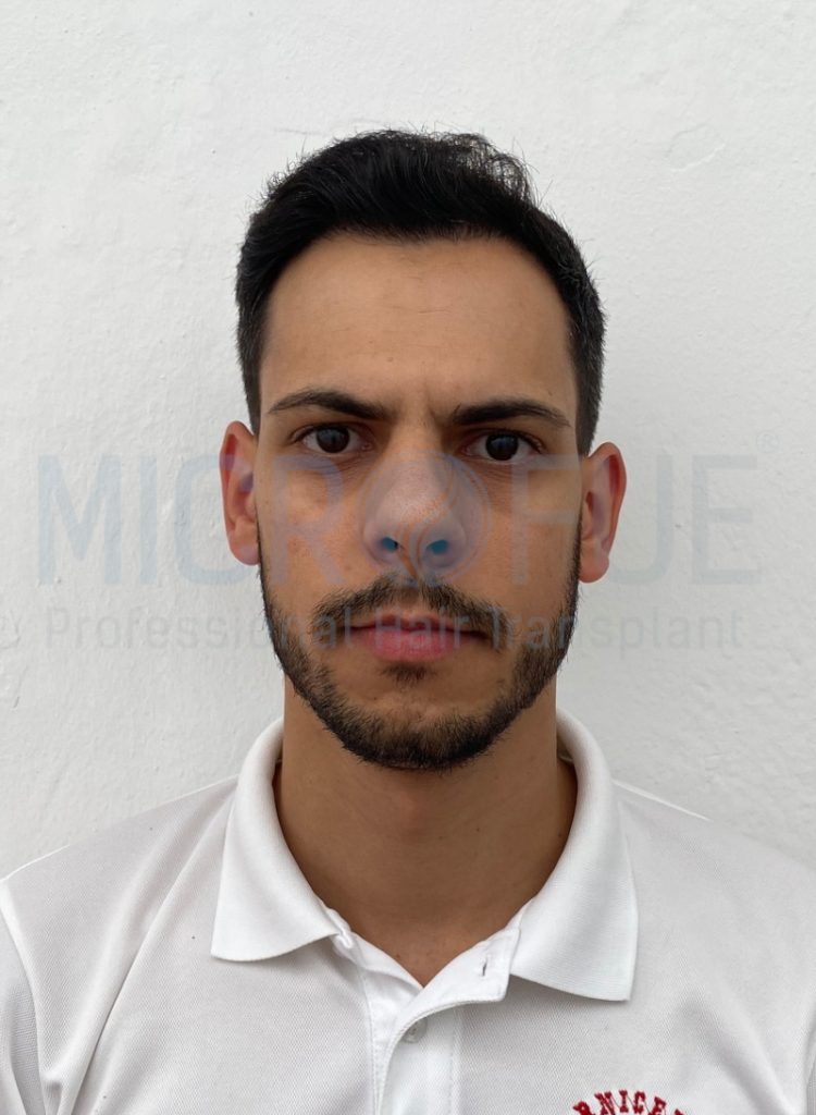 Alfonso Cuellar Romero-frontal-despues frontal despues