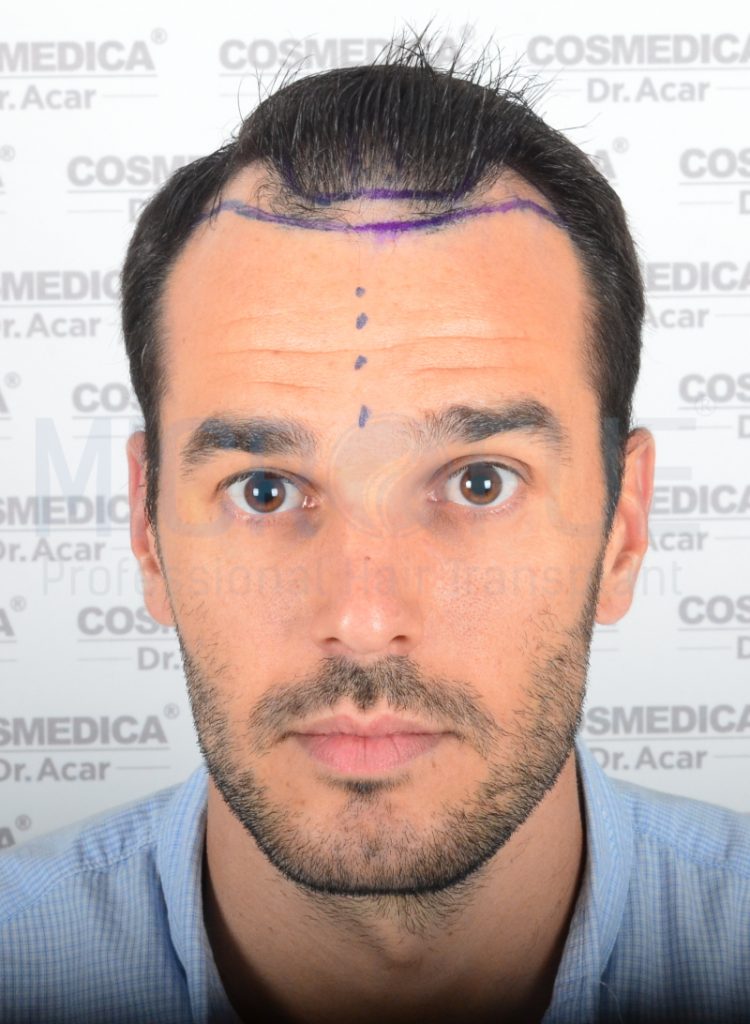 Alfonso Tobar Ruiz-frontal-antes frontal antes