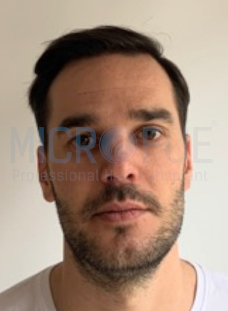 Alfonso Tobar Ruiz-frontal -despues frontal despues