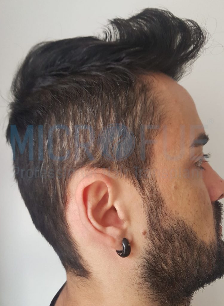 Alonso Gallego Quiceno-lateral #1-despues #6 lateral despues