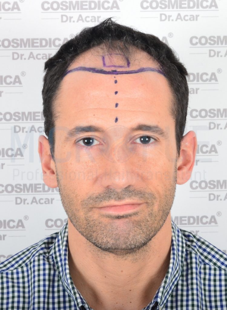 Eloy Molist-frontal #6-antes #20 frontal antes