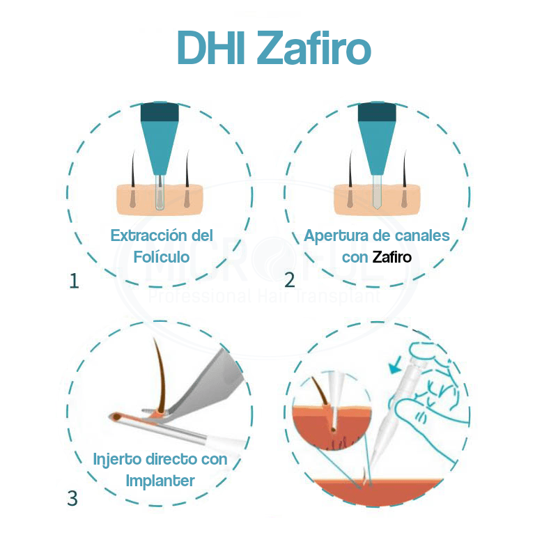 infografia_dhi Injerto capilar DHI zafiro
