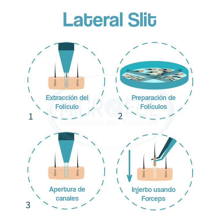 infografia_lateral_slit Infografía injerto capilar técnica Lateral slit