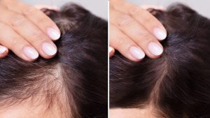 Qué es la alopecia frontal fibrosante
