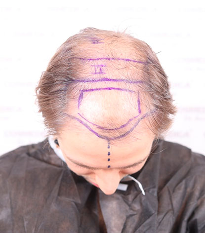 Alopecia avanzada antes del injerto capilar