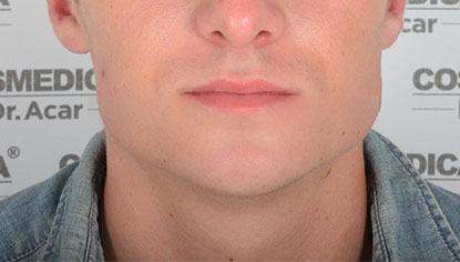 Paciente antes del implante de barba